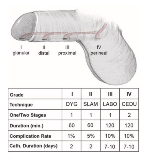 Hipospadiasul este clasificat în patru tipuri principale